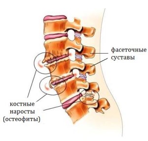 Механизм развития остеохондроза