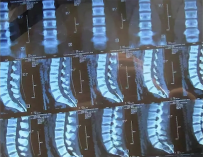 Компьютерная томография пояснично-крестцового отдела позвоночника